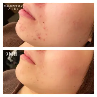 セミロング カラー パーマ ヘアアレンジ メンズ ネイル マツエク・マツパ ニキビ跡専門サロン Ａｉｎａのエステ・リラクイメージ