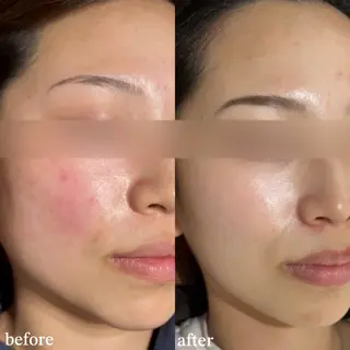 mieux所属・ハーブピーリング ¥6600のエステ・リラクイメージ