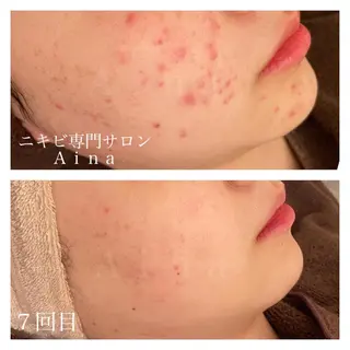 ミディアム カラー パーマ ヘアアレンジ メンズ キッズ ネイル マツエク・マツパ ニキビ跡専門サロン Ａｉｎａのエステ・リラクイメージ