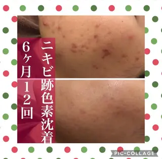 夏までに肌荒れ卒業 するサロン🌻のエステ・リラクイメージ