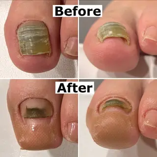 ネイル Mellow nail所属・巻爪無料モデル募集 ✨🦶MEGUMIのネイルデザイン