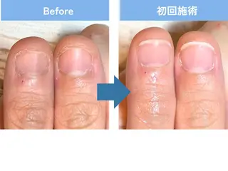 ネイル 深爪矯正・自爪育成 ネイルサロンアモまいのネイルデザイン