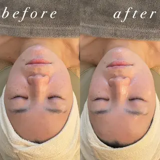 うなじ脱毛/美肌脱毛 LABELのエステ・リラクイメージ