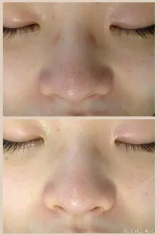 都内で出来る肌管理！ 最短ニキビ改善のエステ・リラクイメージ