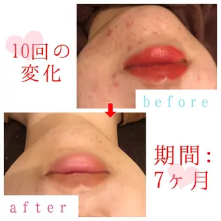 セミロング パーマ ヘアアレンジ メンズ キッズ ネイル マツエク・マツパ 顔タイプ診断 ayakaのエステ・リラクイメージ