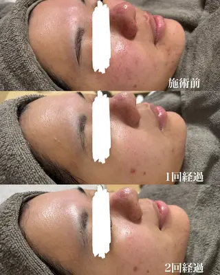 ハーブピーリング専門店lume(ルーム)所属・瀧野 史園のエステ・リラクイメージ