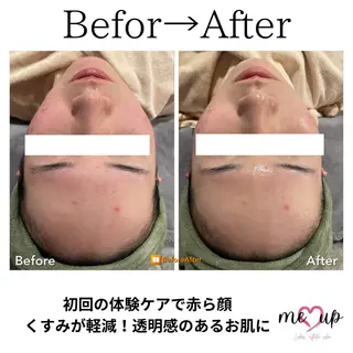 Meupニキビ専門店 背中/ハーブ/肌管理のその他イメージ
