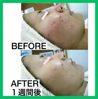 ニキビケア◇ニキビ跡 レゾン京橋店　峠山のエステ・リラクイメージ