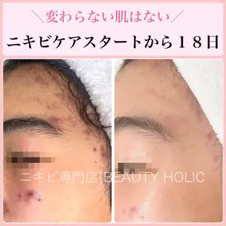 ニキビ・ 肌荒れ専門店のエステ・リラクイメージ