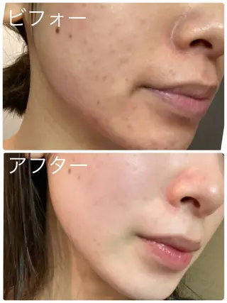 ニキビ･毛穴悩み特化 /CHISATOのエステ・リラクイメージ