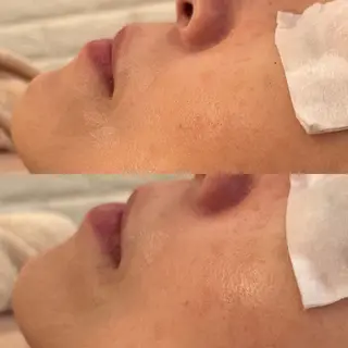 毛穴ケア/毛穴診断/ 毛穴洗浄〔心斎橋〕のエステ・リラクイメージ