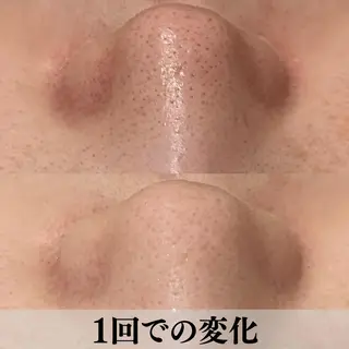 学生ニキビ改善🍀 優しい肌質改善のエステ・リラクイメージ