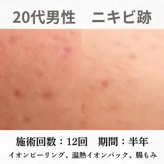 重度ニキビ専門🌷 ダウンタイムなしのエステ・リラクイメージ