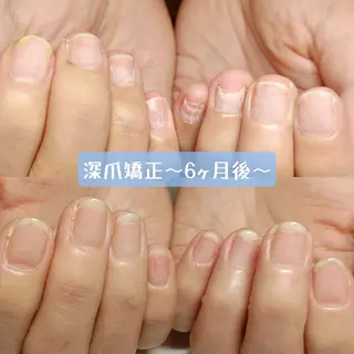 ネイル 深爪矯正/爪育成ケア manie nailのネイルデザイン