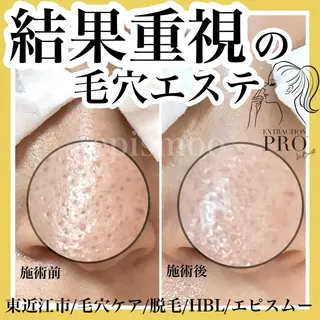 epismoo 脱毛/HBL/毛穴の眉毛・アイブロウイメージ