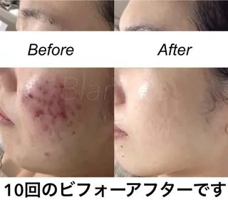 ショート カラー パーマ ヘアアレンジ キッズ ネイル マツエク・マツパ 都度払い肌質改善 &脱毛Blancheのエステ・リラクイメージ