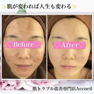 ミディアム カラー パーマ ヘアアレンジ メンズ キッズ ネイル マツエク・マツパ アイブロウ ニキビ・肌質改善専門 ♡人生が変わるサロンのエステ・リラクイメージ