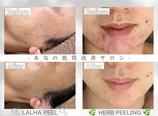 毛穴・ニキビケア　ハーブピーリング【肌管理専門店】WHITE AQUA鳳店所属・ホワイトアクア 鳳店のエステ・リラクイメージ