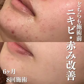 6万人の美肌実績🔥 最短ニキビ改善のエステ・リラクイメージ