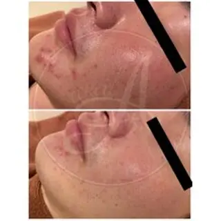 ニキビ跡改善専門🔥 医療にはできない改善のエステ・リラクイメージ