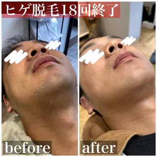 メンズ HAIRS YOSHIOKA所属・ヘアーズヨシオカ MENSヒゲ脱毛のエステ・リラクイメージ