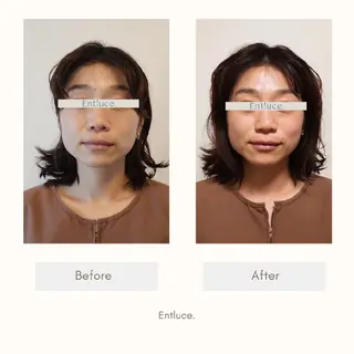 即効⚡小顔美容鍼🪡 むくみたるみ脂肪解消のエステ・リラクイメージ