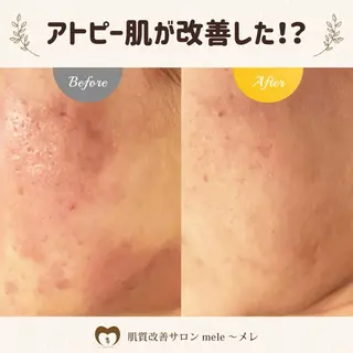 ニキビケア/毛穴/ 赤み/自信の肌✨森園のエステ・リラクイメージ