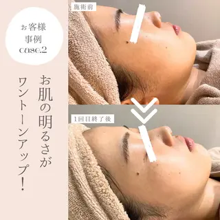 和漢よもぎ蒸しとフェイシャルのお店　maison de beaute所属・よもぎ蒸し/ 大人ニキビ　mamiのエステ・リラクイメージ