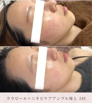 美肌毛穴ケア/看護師 🌷ナスサロmanaのエステ・リラクイメージ