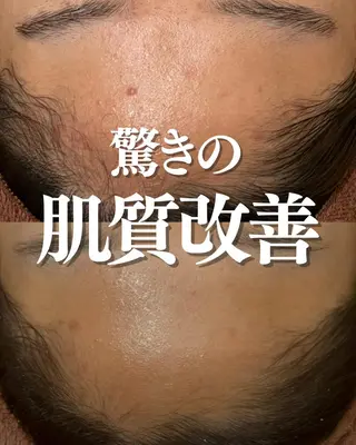 ダウンタイムなし🌷 優しい肌質改善のエステ・リラクイメージ