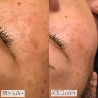 EARTH coiffure beaute 新潟紫竹山店所属・🤍アベシュリ /フェイシャル🤍のエステ・リラクイメージ