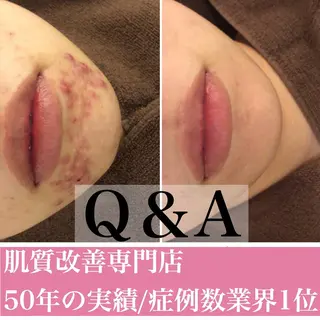 ミディアム カラー パーマ ヘアアレンジ メンズ キッズ ネイル マツエク・マツパ ニキビ・肌質改善専門 ♡人生が変わるサロンのエステ・リラクイメージ