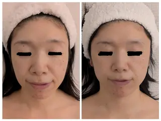 レチノール/ニキビ/ 毛穴ケア 浅川のエステ・リラクイメージ