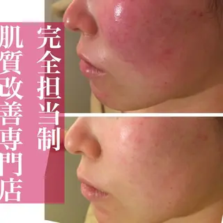ニキビ特化型エステ 🍓最短で肌質改善のエステ・リラクイメージ