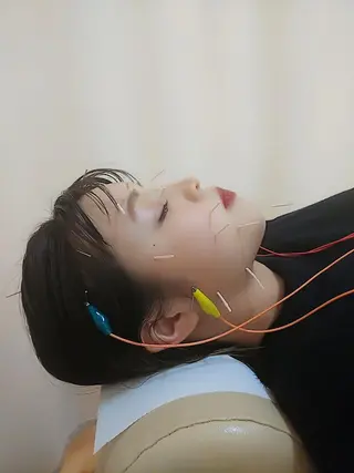 リフトアップ・たるみ ☆美容鍼小顔矯正のその他イメージ