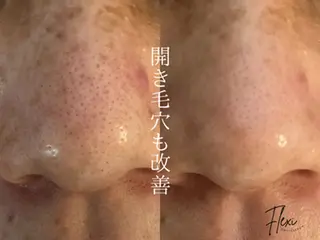 Flexi 表参道所属・🌟ニキビ・毛穴ケア 🌿Flexi表参道のエステ・リラクイメージ