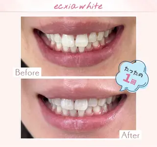 エクシアホワイト調布所属・umi❤︎ ホワイトニングのその他イメージ