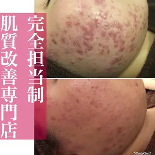 6万人の美肌実績🔥 最短ニキビ改善のエステ・リラクイメージ