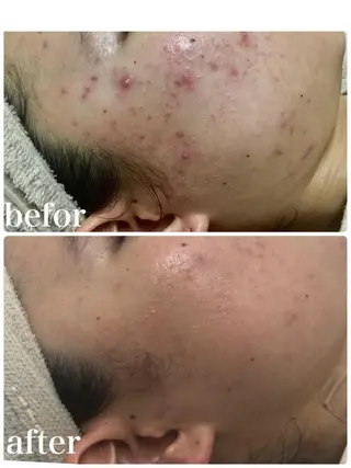 Meupニキビ専門店 背中/ハーブ/肌管理のその他イメージ