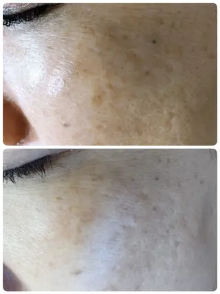 角質・毛穴洗浄🌼 脱毛🌸嶋津弘美のエステ・リラクイメージ