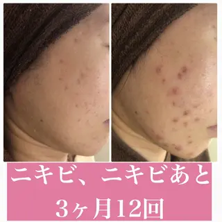 ニキビ跡改善専門🔥 医療にはできない改善のエステ・リラクイメージ