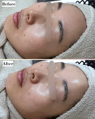 |ピーリング・毛穴| soina神楽坂のエステ・リラクイメージ