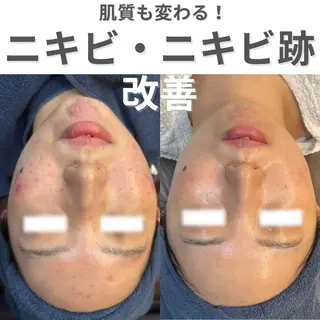ニキビ・ニキビ跡改善 leoloのエステ・リラクイメージ