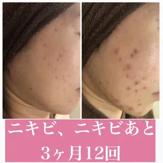 夏までに肌荒れ卒業 するサロン🌻のエステ・リラクイメージ