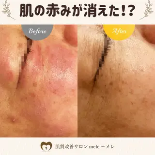 ニキビケア/毛穴/ 赤み/自信の肌✨森園のエステ・リラクイメージ