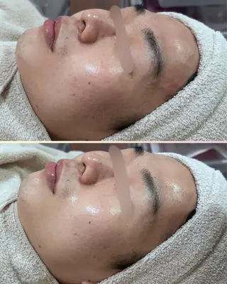 |ピーリング・毛穴| soina神楽坂のエステ・リラクイメージ