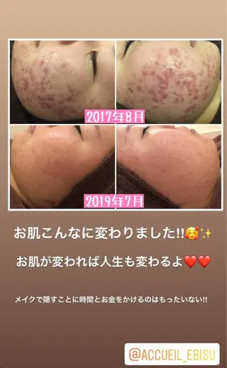 ミディアム カラー パーマ ヘアアレンジ メンズ キッズ ネイル マツエク・マツパ ニキビ・肌質改善専門 ♡人生が変わるサロンのエステ・リラクイメージ