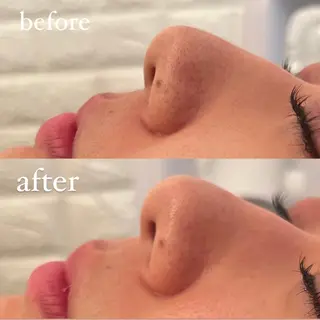 毛穴ケア/毛穴診断/ 毛穴洗浄〔心斎橋〕のエステ・リラクイメージ