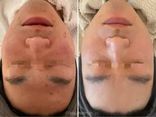 肌質改善 KALANCHOEのエステ・リラクイメージ