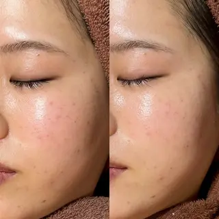 mieux所属・ハーブピーリング ¥6600のエステ・リラクイメージ